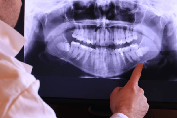 Best Emergency Wisdom Teeth Removal in Holt, AL